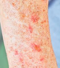 It over to become cancerous. Actinic Keratosis Long Island Skin Cancer Skin Cancer Treatment