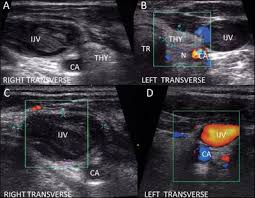 However if the ultrasound would be limited to the neck and not the actual throat i'd have the endoscopy done. Abnormal Jugular Vein Detected During Thyroid Ultrasound