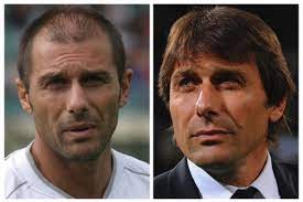 Del resto, la differenza tra prima e. Nadal Come Conte Quando Il Trapianto Di Capelli E Sportivo