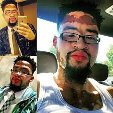 These People With Vitiligo Remind Us That What Describes Us Doesn't Define  Us