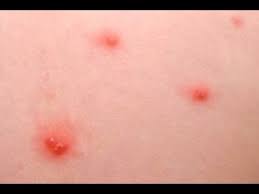 Vucutta Kirmizi Lekeler Hakkinda Bilgi Youtube