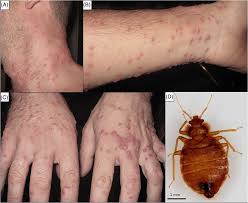 Image result for Cimex lectularius bites