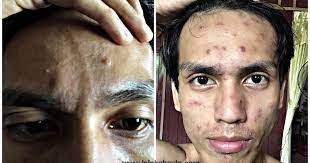Petua hilang demam campak dewasa. Hilangkan Parut Chicken Pox Untuk Orang Dewasa Jejakakaula