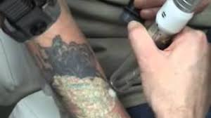 San diego laser removal clinic (sdlr) started in partnership with propaganda tattoo in 2010. Tattoo Removal San Diego Laser Tattoo Removal La Jolla