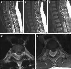 Spinal Epidural Hematoma Extending From C6 C7 To T2 Level Download Scientific Diagram