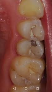 Maybe you would like to learn more about one of these? Relativ Tiefes Loch Im Zahn Nur Bohren Oder Wurzelbehandlung Zahnarzt Karies