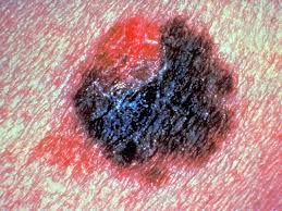 It can spread very quickly and become deadly. Signs You Have Skin Cancer