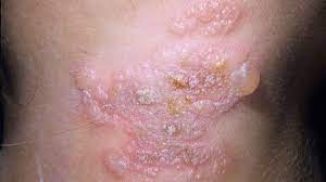 What are the first signs of a sti? Do You Have An Std You Re Not The Only One Everyday Health