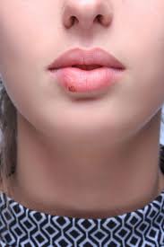 Ulcerele herpetiforme sunt si ele recurente, sunt foarte rare la copii, apar in general. Rusine Surrey VarÄ Afte Bucale La Copii Proprint Ro