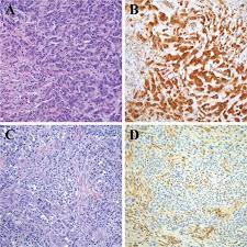 When cancerous tumors form on connective tissues, it is a sarcoma. Mtap Immunohistochemistry Is An Accurate And Reproducible Surrogate For Cdkn2a Fluorescence In Situ Hybridization In Diagnosis Of Malignant Pleural Mesothelioma Modern Pathology