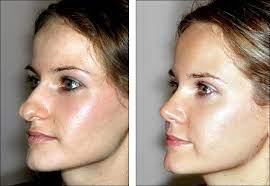 22 Cosmetic Surgery Gone Right Ideas Cosmetic Surgery Self Image Surgery