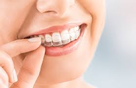 Zertifizierter provider von invisalign®, inkognito® und. Invisalign Unsichtbare Zahnspange Die Haufigsten Fragen Minimed At