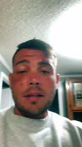 KEEP THIS IN MIND, I ACTUALLY GOT THE GOOD END OF THIS DEAL COMPARED TO  MOST FIREWORK INJURIES #firework #awareness #fypシ゚viral #foryoupage #viral  #trending