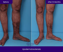 Image result for Lipodermatosclerosis