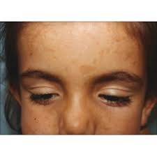 Pritesh Sheth, Author at Indian Journal of Dermatology, Venereology and  Leprology