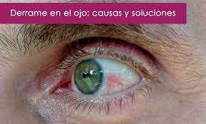 Derrame En El Ojo Por Que Ocurre Y Que Hacer