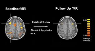In addition, altered serotonergic neurotransmission has been repeatedly implicated in the pathophysiology of migraine, although the exact mechanism is not known. Epos Trade