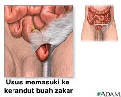 Dulu aku tinggal bersama kedua orang tuaku di sebuah kompleks. Hernia Jenis Penyebab Dan Cara Rawatan Wannura Terapi