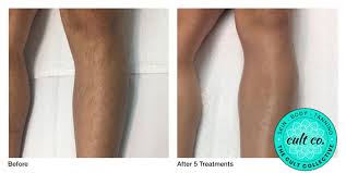 Light pulses are used to damage hair follicles, and impair their ability to grow hair. Ipl Permanent Hair Removal The Cult Collective