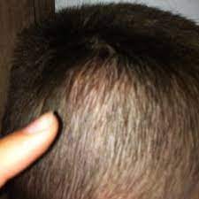 Mein Bruder Hat Eine Beule Am Kopf Normal