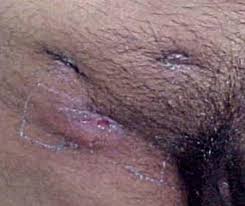 Most infections show no symptoms, in which case it is known as latent tuberculosis. Scielo Brasil Cutaneous Tuberculosis Epidemiologic Etiopathogenic And Clinical Aspects Part I Cutaneous Tuberculosis Epidemiologic Etiopathogenic And Clinical Aspects Part I