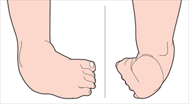 Image result for Clubfoot