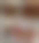 Image result for Purse String Suture