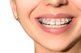 Braces not only fill the gap but they also make sure that your teeth are in perfect shape. Dental Treatments For Fixing Your Teeth Gaps