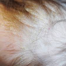 Image result for white scabs on the head in children