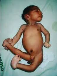 Almost 75% of babies with edwards syndrome, or trisomy 18, are miscarried or stillborn. Edwards Syndrome