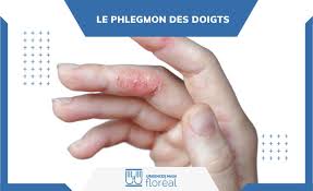 Image result for phlegmon of hand)