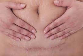 C Section Scar Infection Types Reasons Signs Treatment