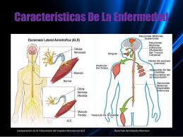 La esclerosis lateral amiotrófica es una enfermedad progresiva y de mal pronóstico que provoca debilidad de los. Esclerosis Lateral Amiotrofica