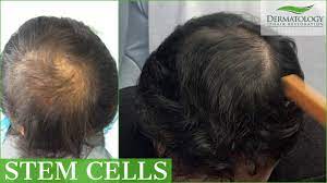 Hope of a future treatment for hair regrowth. Stem Cell Prp Therapy For Hair Loss With Three Month Update Youtube