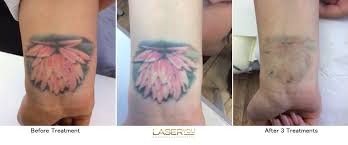 You may be able to find the same content in another format, or you may be able to find. Laser Tattoo Removal Using Picosure Laseryou Picosure Tattoo Removal Skin Rejuvenation Soprano Titanium Ice Hair Removal