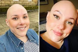 Essex campaigner with alopecia fighting to stop the stare