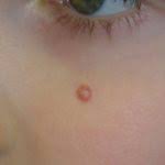We did not find results for: Sporotrichosis Rose Gardener S Disease Dermatology Advisor