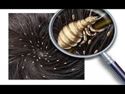 هل تعلم ما أسباب ظهور قمل شعر الرأس عند الأطفال Youtube Head Louse Lice Removal Coconut Oil Lice