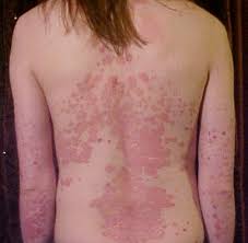 The cause of psoriasis is unknown but a number of risk factors are suspected. Psoriasis Wikipedia