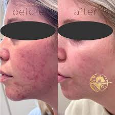 Aerolase Laser Treatments in Middleton for acne and skin rejuvenation with  Dr. Sama Alshora — Artemis 22