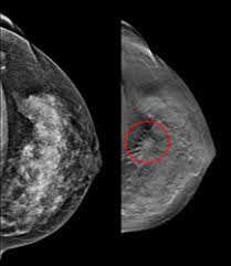 Treatment typically involves some type of surgery and depends upon the staging of the. Article On Mammography Standard Of Care