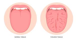 Image result for Fissured tongue