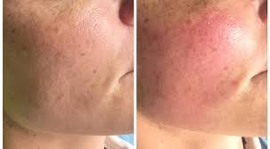 Check spelling or type a new query. Hifu Behandlung Gottlich Schon