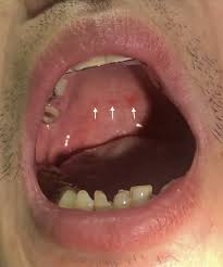 Image result for Physical injury red spots roof of mouth