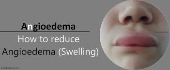 Image result for Angioedema