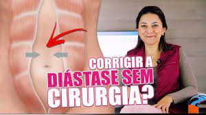 como corrigir a diastase sem cirurgia youtube diastase abdominal controle de peso rotina de exercicios