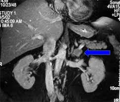 Image result for Hyperaldosteronism