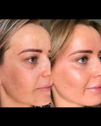 I heard you're in need of a skin refresh? 🫧🗓️🧖🏼‍♀️ Chemical peels