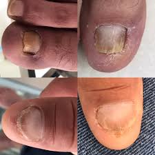 Se daña primero la raíz de la uña. Hongos En Las Unas Eliminalos Con Aplicacion De Laser Clinica Yupi