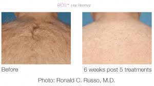 Elos hair removal is hair removal, using the elos technology. Elos Hair Removal Estevan Laser Health Clinic